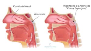 Hipertrofia de Adenoide